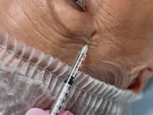 Close-up of the eye area during a non-surgical eyelid rejuvenation assessment