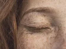 Swollen lump on the eyelid margin from a stye or chalazion