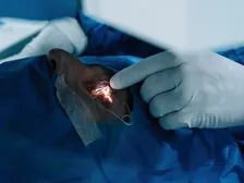 Excimer laser reshaping the cornea during refractive vision correction surgery.