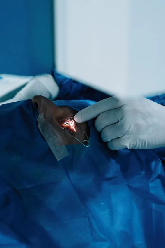 Excimer laser reshaping the cornea during refractive vision correction surgery.