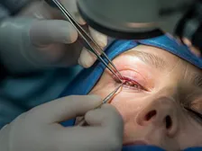 Upper eyelid drooping over the eye before ptosis correction
