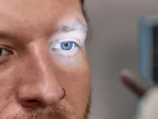 Lower eyelid turned outward away from the eye surface in ectropion
