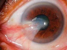Eye with a pterygium growing from the white of the eye toward the cornea