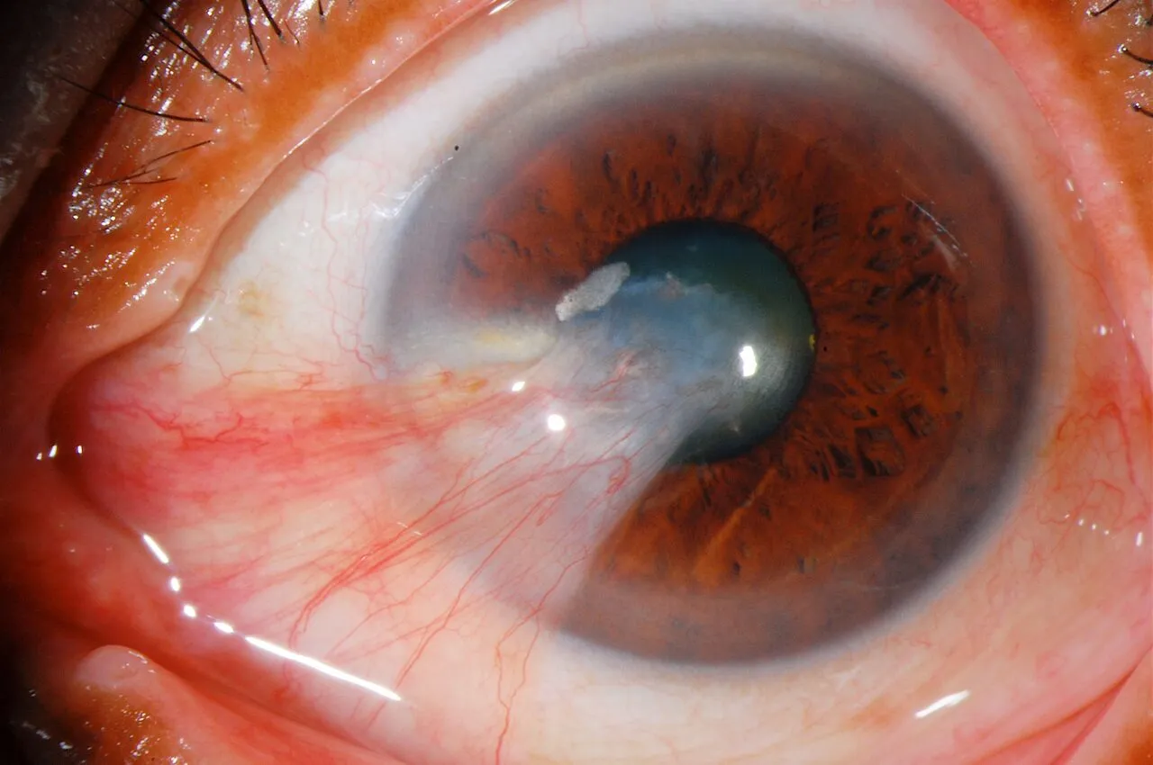 Eye with a pterygium growing from the white of the eye toward the cornea