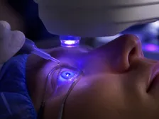 An eye undergoing corneal cross-linking with UV-A light after riboflavin application