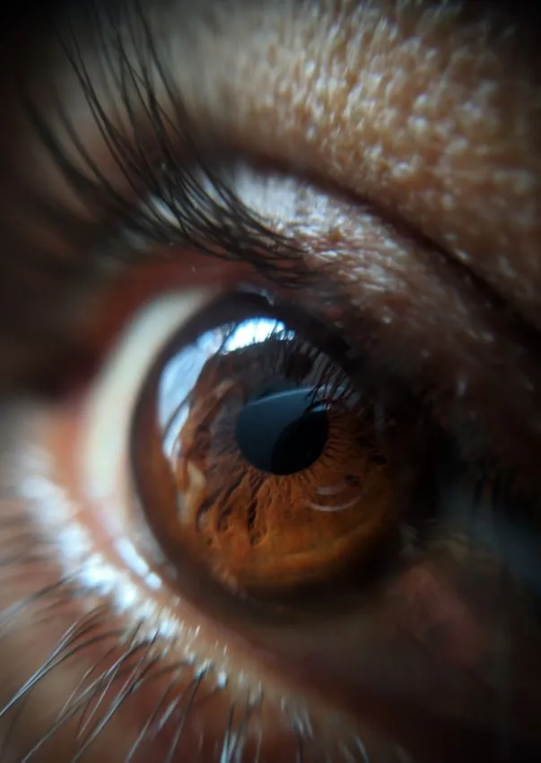 Probe dilating the punctum at the inner corner of the eyelid