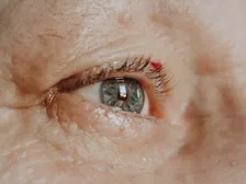 Close-up of an eye showing a clouded lens typical of a cataract