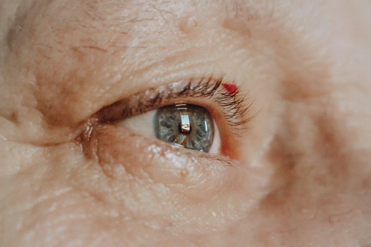 Close-up of an eye showing a clouded lens typical of a cataract