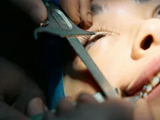 Vitrectomy surgery removing the vitreous gel to repair the retina