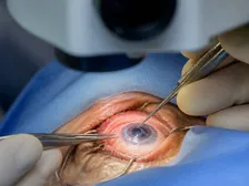 Clear donor cornea sutured into place during a corneal transplant